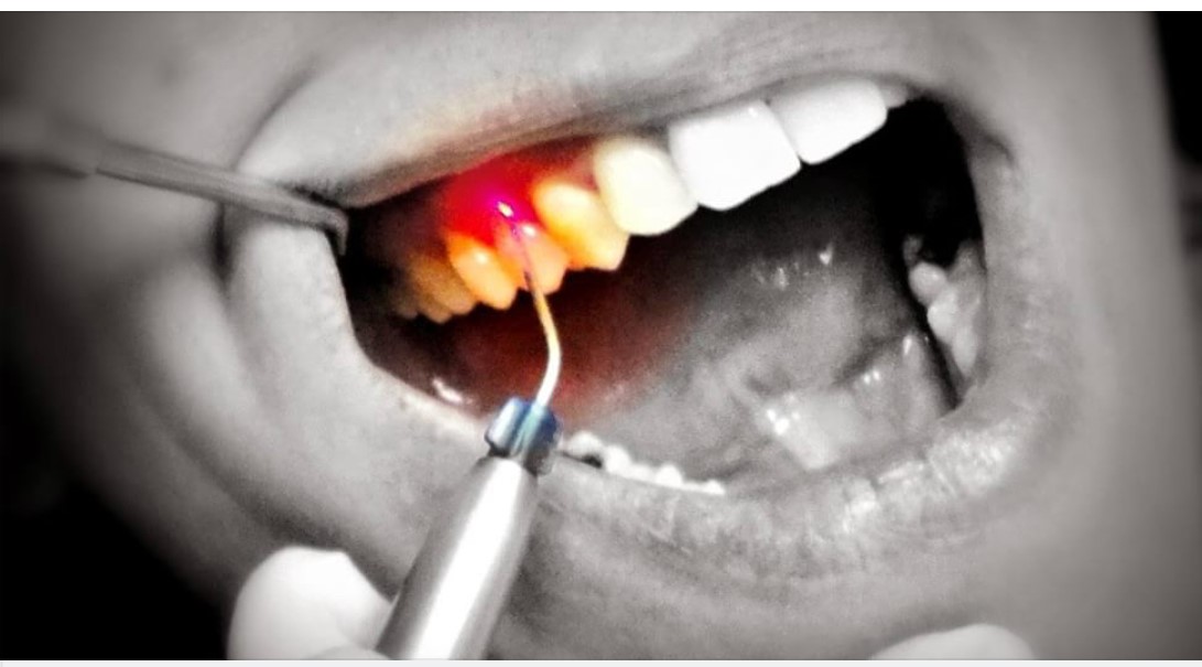 El láser en odontología, gran herramienta para el sector dental